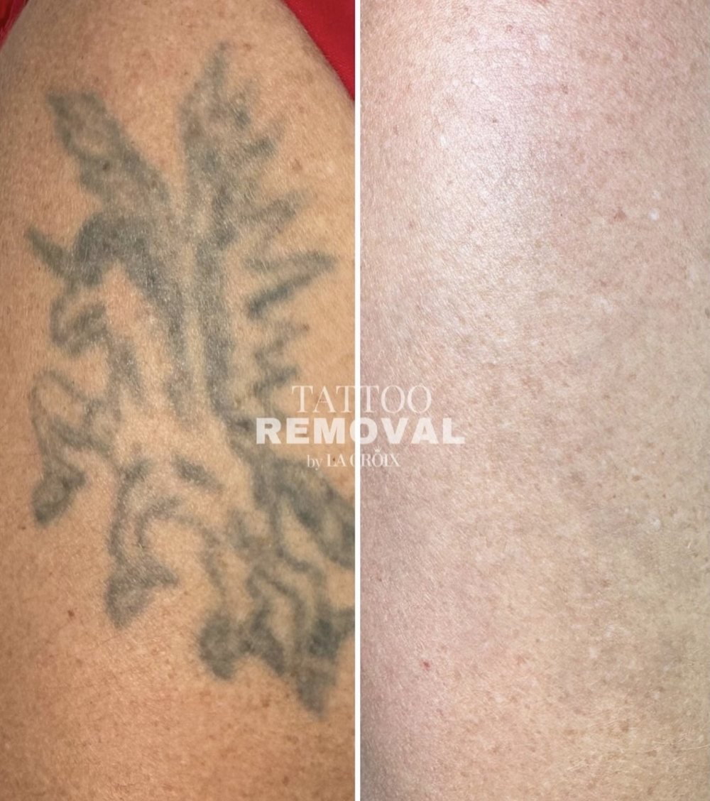 Antes y después: tatuaje en el brazo eliminado con láser