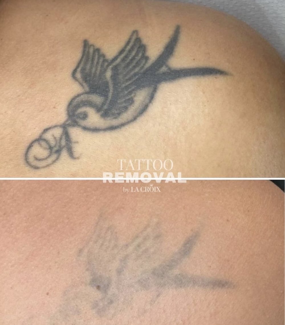 Antes y después: tatuaje de golondrina aclarado con láser